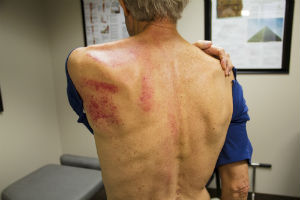 Graston Technique Bruise